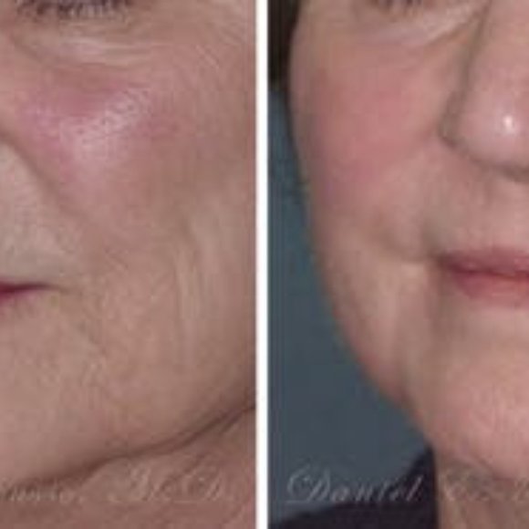 25% TCA Facial Peel - Picture 3 of 6